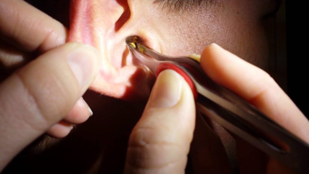 Earwax3 جرم گوش